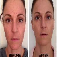معرفی میکرودرم ابریژن (MicroDerm Abrasion)